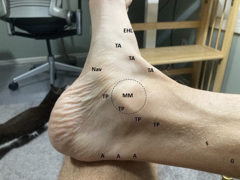 Tibialis Posterior Tendinopathy&nbsp;Strikes